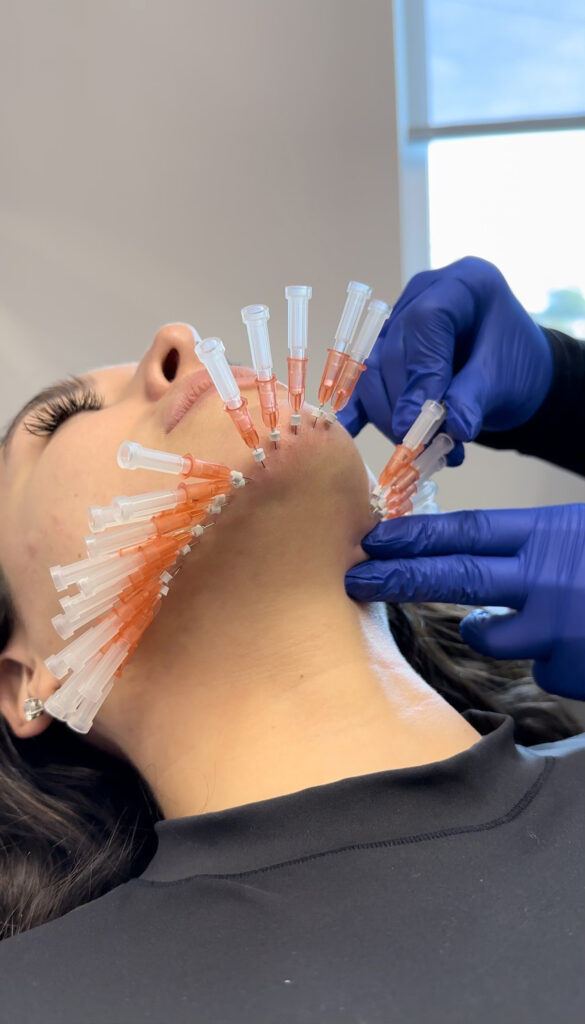 pdo thread lift procedure being conducted at a houston med spa