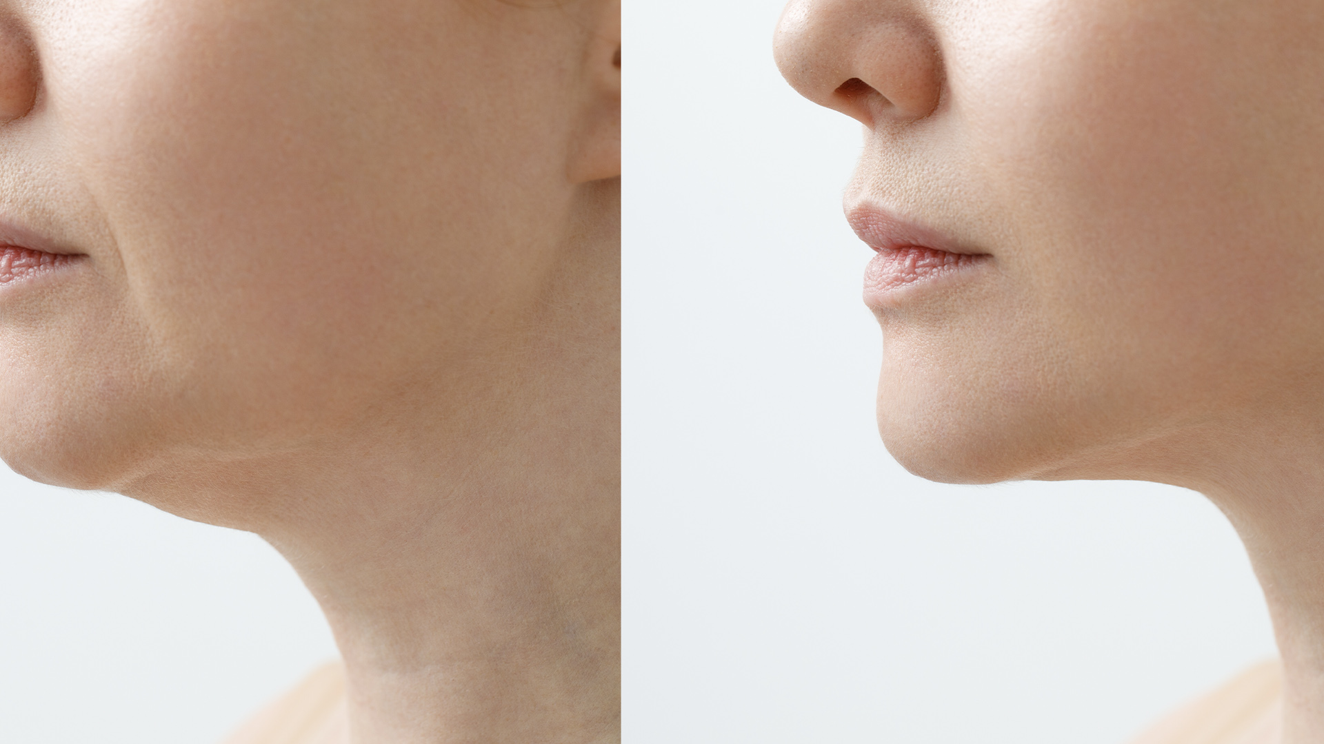 Kybella for Double Chin – Injection in Houston TX