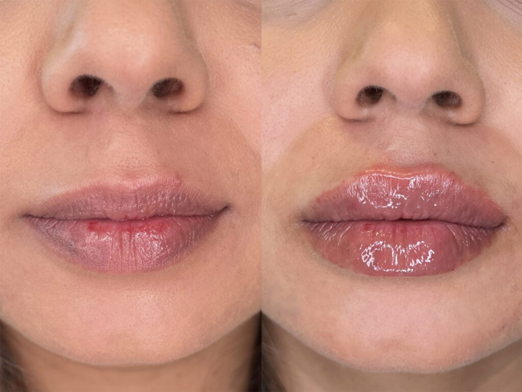 lip fillers before and after