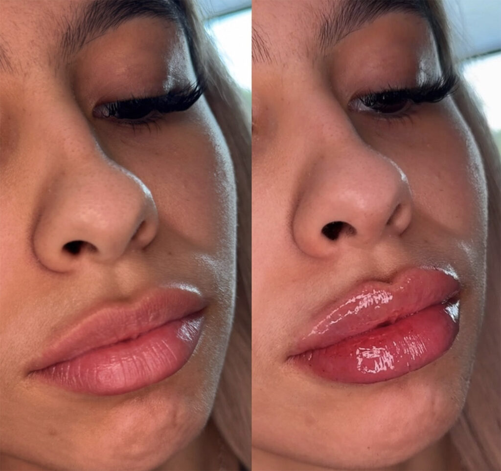 patient showing off pout after getting lip fillers