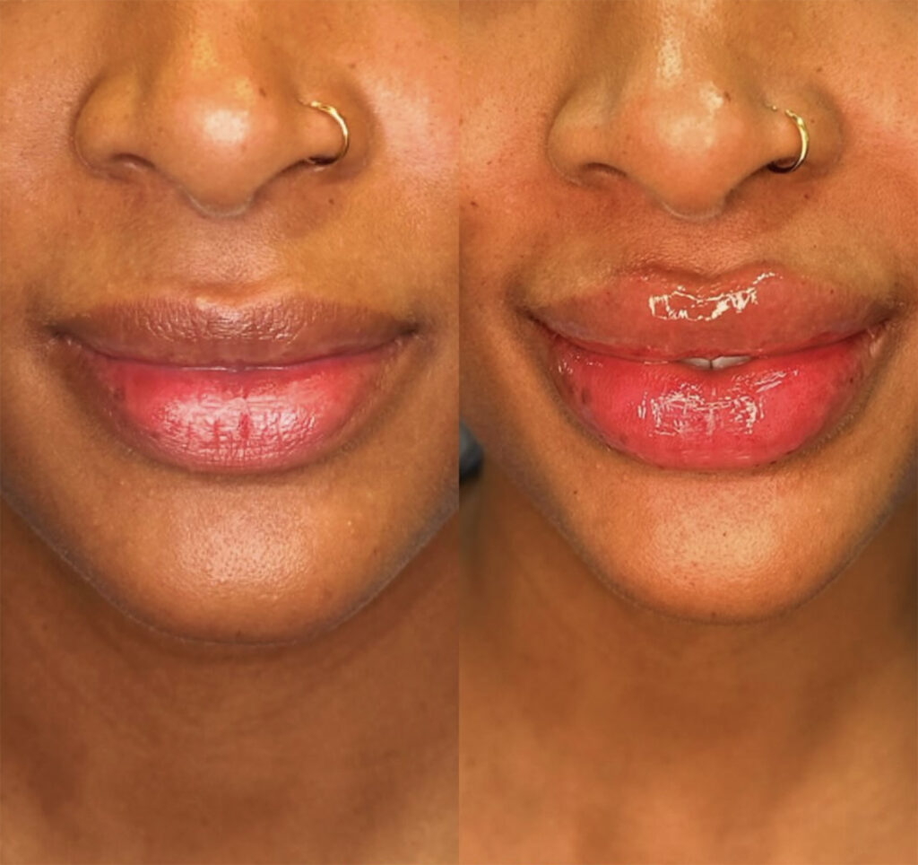 immediate results of lip augmentation