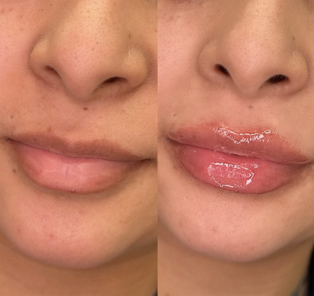 houston lip fillers just performed at aesthetic lab