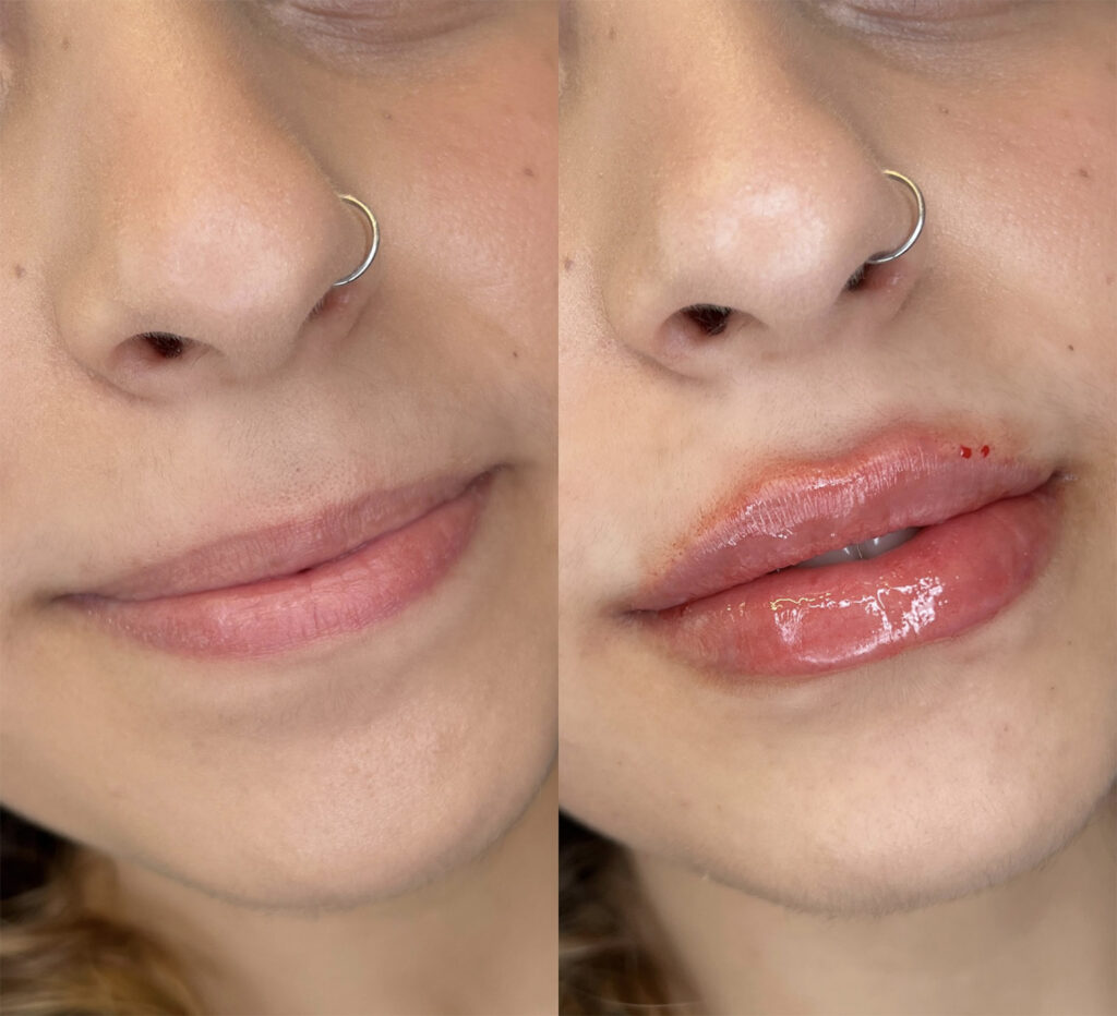 patient who had lip fillers at our houston med spa