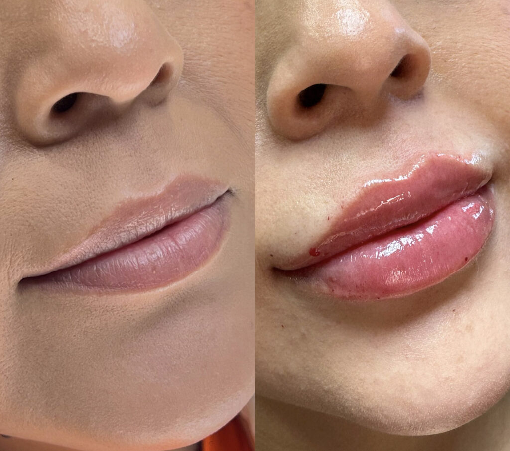 immediate results of lip filler injections