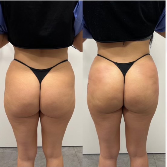 Houston Med Spa showcasing a before and after of a Sculptra Butt Lift